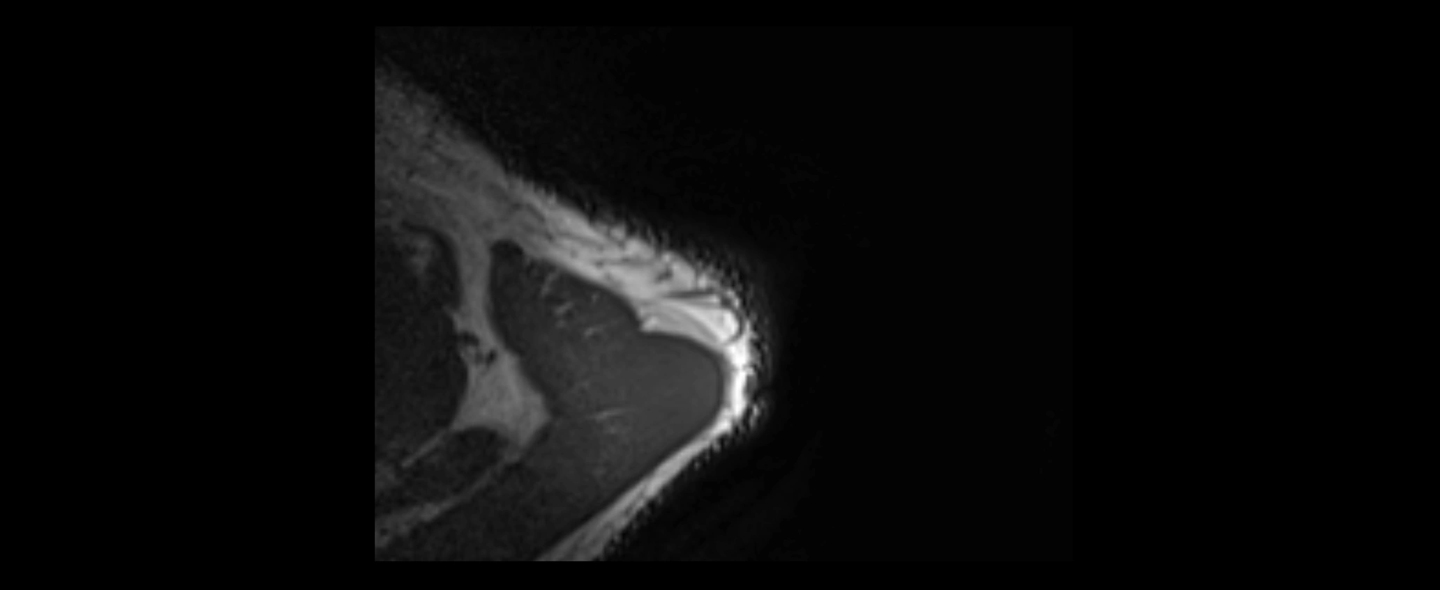 shoulder ligaments axial 3d 3t mri image-img-00005-00006.webp